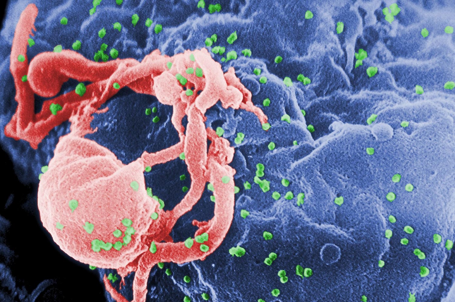 Varian HIV Yang Lebih Ganas Ditemukan Di Belanda